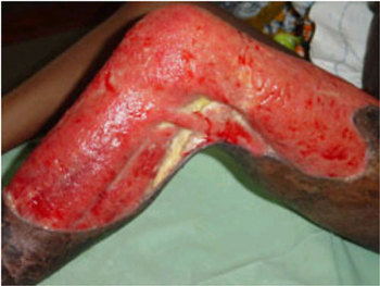 エボラ熱　感染2014年6月19日.jpg